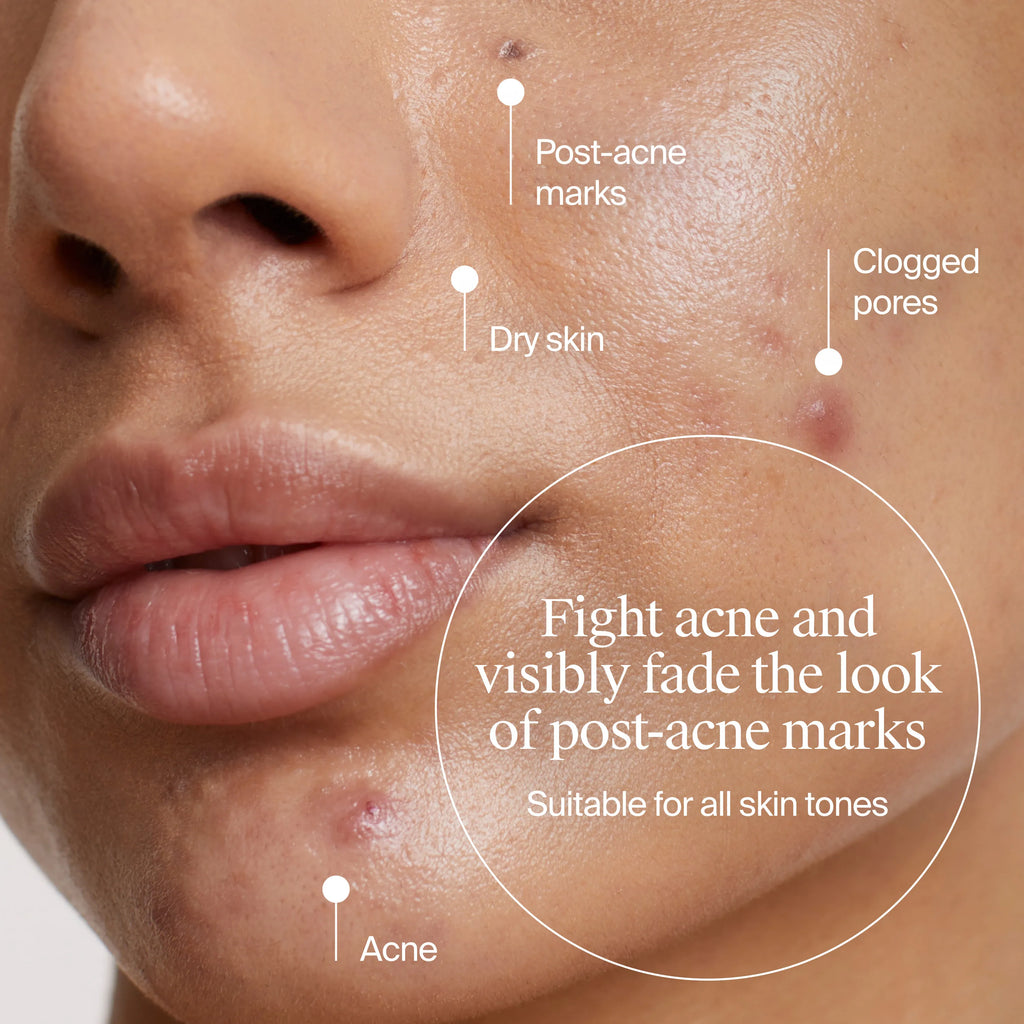 Neutrogena Acne-Fighting Skincare Solutions | Evenly Clear Cleanser + Acne Gel Moisturizer