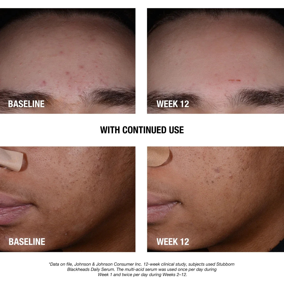 Neutrogena Stubborn Blackheads Daily | 1 Fl. Oz Acne Facial Serum
