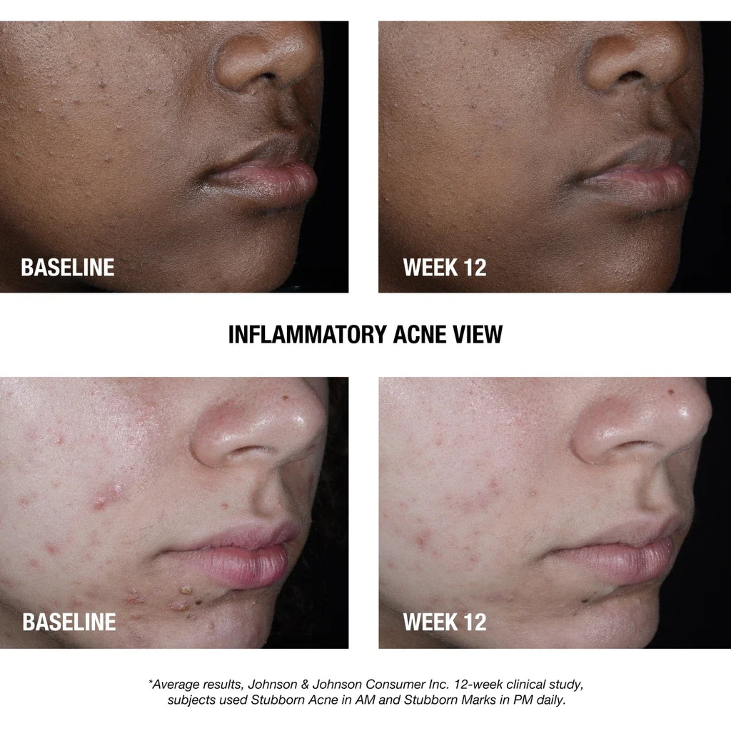 Neutrogena Stubborn Acne AM | 2.5% Benzoyl Peroxide Treatment, 2 Oz